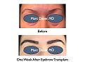 Click image for larger version

Name:	Hair Transplant Slides.672.jpg
Views:	321
Size:	55.2 KB
ID:	473828
