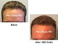 Click image for larger version

Name:	Hair Transplant Slides.673.jpg
Views:	403
Size:	60.2 KB
ID:	473892