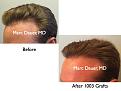 Click image for larger version

Name:	Hair Transplant Slides.674.jpg
Views:	379
Size:	63.4 KB
ID:	473893