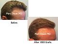 Click image for larger version

Name:	Hair Transplant Slides.675.jpg
Views:	452
Size:	65.4 KB
ID:	473894