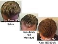 Click image for larger version

Name:	Hair Transplant Slides.676.jpg
Views:	395
Size:	76.2 KB
ID:	473895