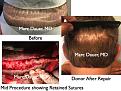 Click image for larger version

Name:	Hair Transplant Slides.677.jpg
Views:	406
Size:	92.6 KB
ID:	473896