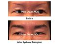 Click image for larger version

Name:	Hair Transplant Slides.683.jpg
Views:	262
Size:	64.1 KB
ID:	473913