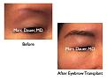 Click image for larger version

Name:	Hair Transplant Slides.684.jpg
Views:	250
Size:	57.5 KB
ID:	473914