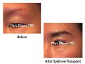 Click image for larger version

Name:	Hair Transplant Slides.685.jpg
Views:	251
Size:	57.9 KB
ID:	473915