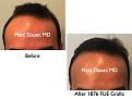 Click image for larger version

Name:	Hair Transplant Slides.689.jpg
Views:	348
Size:	55.5 KB
ID:	473937