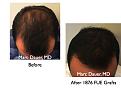 Click image for larger version

Name:	Hair Transplant Slides.692.jpg
Views:	336
Size:	56.9 KB
ID:	473938
