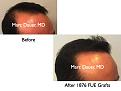 Click image for larger version

Name:	Hair Transplant Slides.691.jpg
Views:	319
Size:	53.3 KB
ID:	473939