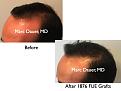 Click image for larger version

Name:	Hair Transplant Slides.690.jpg
Views:	356
Size:	52.6 KB
ID:	473940