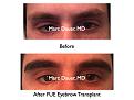 Click image for larger version

Name:	Hair Transplant Slides.686.jpg
Views:	1611
Size:	60.6 KB
ID:	473950