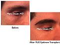Click image for larger version

Name:	Hair Transplant Slides.687.jpg
Views:	401
Size:	66.7 KB
ID:	473951