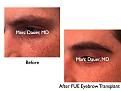 Click image for larger version

Name:	Hair Transplant Slides.688.jpg
Views:	410
Size:	63.3 KB
ID:	473952