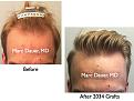 Click image for larger version

Name:	Hair Transplant Slides.707.jpg
Views:	360
Size:	73.3 KB
ID:	473984