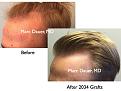 Click image for larger version

Name:	Hair Transplant Slides.708.jpg
Views:	328
Size:	71.7 KB
ID:	473985