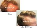 Click image for larger version

Name:	Hair Transplant Slides.709.jpg
Views:	315
Size:	66.7 KB
ID:	473986