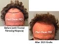 Click image for larger version

Name:	Hair Transplant Slides.716.jpg
Views:	462
Size:	77.6 KB
ID:	474070
