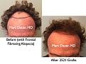 Click image for larger version

Name:	Hair Transplant Slides.716.jpg
Views:	367
Size:	77.6 KB
ID:	474070