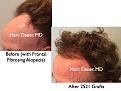 Click image for larger version

Name:	Hair Transplant Slides.717.jpg
Views:	366
Size:	77.2 KB
ID:	474071