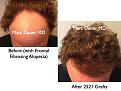 Click image for larger version

Name:	Hair Transplant Slides.719.jpg
Views:	433
Size:	81.8 KB
ID:	474073