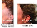 Click image for larger version

Name:	Hair Transplant Slides.720.jpg
Views:	615
Size:	92.0 KB
ID:	474074