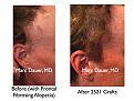Click image for larger version

Name:	Hair Transplant Slides.721.jpg
Views:	380
Size:	83.2 KB
ID:	474075