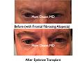 Click image for larger version

Name:	Hair Transplant Slides.722.jpg
Views:	469
Size:	69.4 KB
ID:	474076