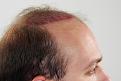 Click image for larger version

Name:	sd imm post-op R side.jpg
Views:	409
Size:	92.1 KB
ID:	474160