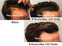 Click image for larger version

Name:	Hair Transplant Slides.737.jpg
Views:	333
Size:	81.7 KB
ID:	474226