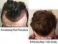 Click image for larger version

Name:	Hair Transplant Slides.738.jpg
Views:	355
Size:	91.5 KB
ID:	474227