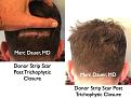 Click image for larger version

Name:	Hair Transplant Slides.739.jpg
Views:	349
Size:	92.0 KB
ID:	474228