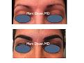 Click image for larger version

Name:	Hair Transplant Slides.743.jpg
Views:	318
Size:	58.5 KB
ID:	474297