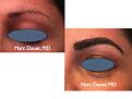 Click image for larger version

Name:	Hair Transplant Slides.745.jpg
Views:	307
Size:	56.5 KB
ID:	474299