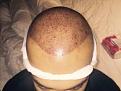 Click image for larger version

Name:	post op immedi.jpg
Views:	586
Size:	14.0 KB
ID:	474337