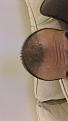 Click image for larger version

Name:	25 days post op.jpg
Views:	480
Size:	92.9 KB
ID:	474340