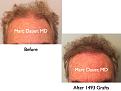 Click image for larger version

Name:	Hair Transplant Slides.746.jpg
Views:	337
Size:	62.5 KB
ID:	474430