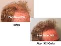 Click image for larger version

Name:	Hair Transplant Slides.748.jpg
Views:	314
Size:	62.2 KB
ID:	474432