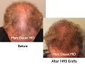 Click image for larger version

Name:	Hair Transplant Slides.749.jpg
Views:	344
Size:	78.4 KB
ID:	474433
