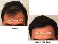 Click image for larger version

Name:	Hair Transplant Slides.750.jpg
Views:	364
Size:	62.1 KB
ID:	474480