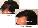 Click image for larger version

Name:	Hair Transplant Slides.751.jpg
Views:	336
Size:	62.7 KB
ID:	474481