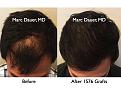 Click image for larger version

Name:	Hair Transplant Slides.753.jpg
Views:	364
Size:	82.1 KB
ID:	474483