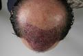 Click image for larger version

Name:	sd imm post-op chin down.jpg
Views:	330
Size:	91.7 KB
ID:	474520