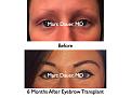 Click image for larger version

Name:	Hair Transplant Slides.755.jpg
Views:	284
Size:	62.0 KB
ID:	474728