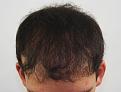 Click image for larger version

Name:	sp 1 year post chin down.jpg
Views:	504
Size:	92.4 KB
ID:	474750