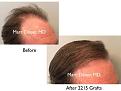 Click image for larger version

Name:	Hair Transplant Slides3.003.jpg
Views:	370
Size:	12.6 KB
ID:	474756