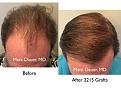 Click image for larger version

Name:	Hair Transplant Slides3.004.jpg
Views:	300
Size:	16.4 KB
ID:	474757