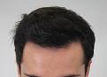 Click image for larger version

Name:	hair transplant 7 mos post 4.jpg
Views:	998
Size:	82.2 KB
ID:	474826