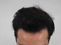 Click image for larger version

Name:	hair transplant 7 mos post 5.jpg
Views:	856
Size:	85.7 KB
ID:	474827