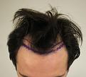 Click image for larger version

Name:	hair transplant before 5.jpg
Views:	1389
Size:	75.2 KB
ID:	474828