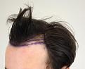 Click image for larger version

Name:	hair transplant before 3.jpg
Views:	1102
Size:	81.9 KB
ID:	474829