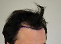 Click image for larger version

Name:	hair transplant before 4.jpg
Views:	888
Size:	80.6 KB
ID:	474830